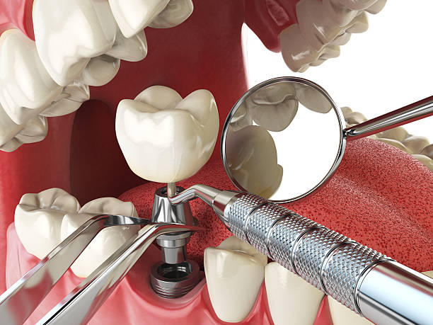 Best Emergency Root Canal Treatment in Little Walnut Village, NM